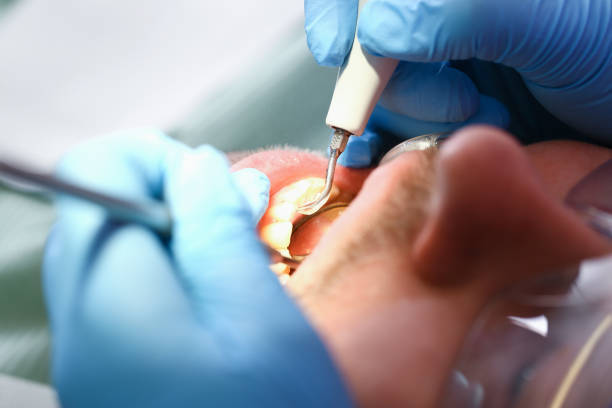 Best Emergency Dental Care for Abscessed Tooth in Auburn Hills, MI