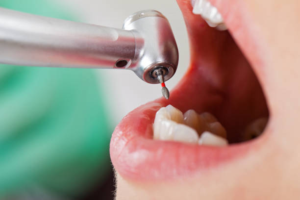 Best Broken or Cracked Tooth Emergency Dentist in Auburn Hills, MI